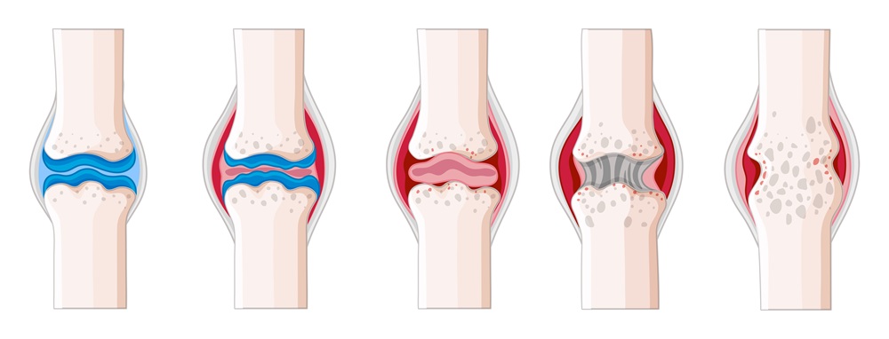Az osteoarthritis szakaszai.