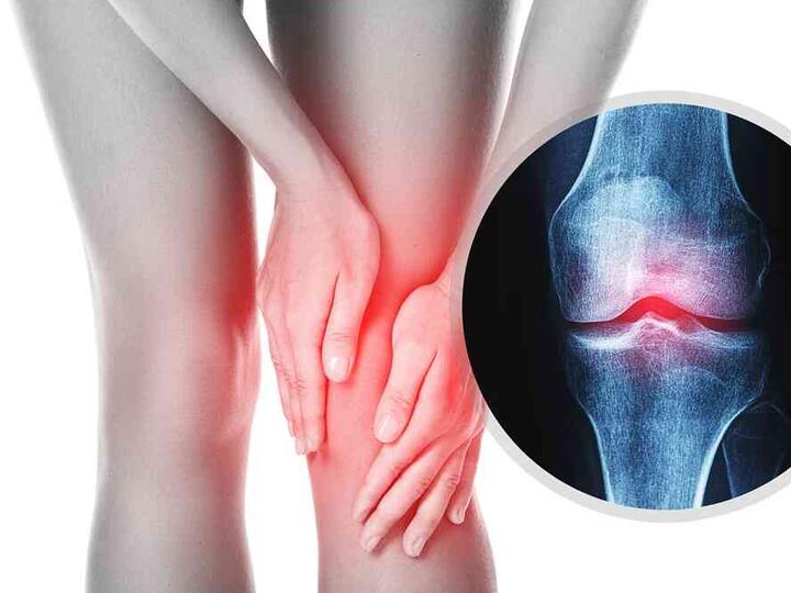 Hogyan lehet megszabadulni az artrózistól?