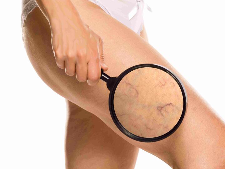 Visszér - kialakulása, megelőzése és kezelése