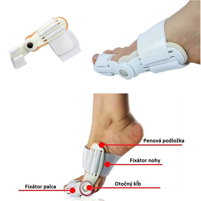 Hallux Valgus korrekciós sín - éjjeli és nappali használatra
